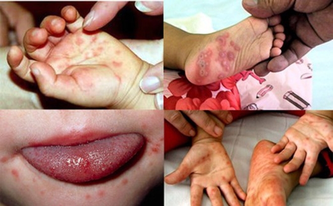 Bệnh tay chân miệng ở trẻ em (Hand-Foot-and-Mouth Disease)